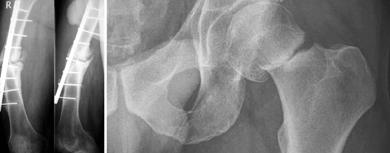 Pseudarthrosis (Nonunion): Why a Fracture Fails to Heal and How It Is Treated